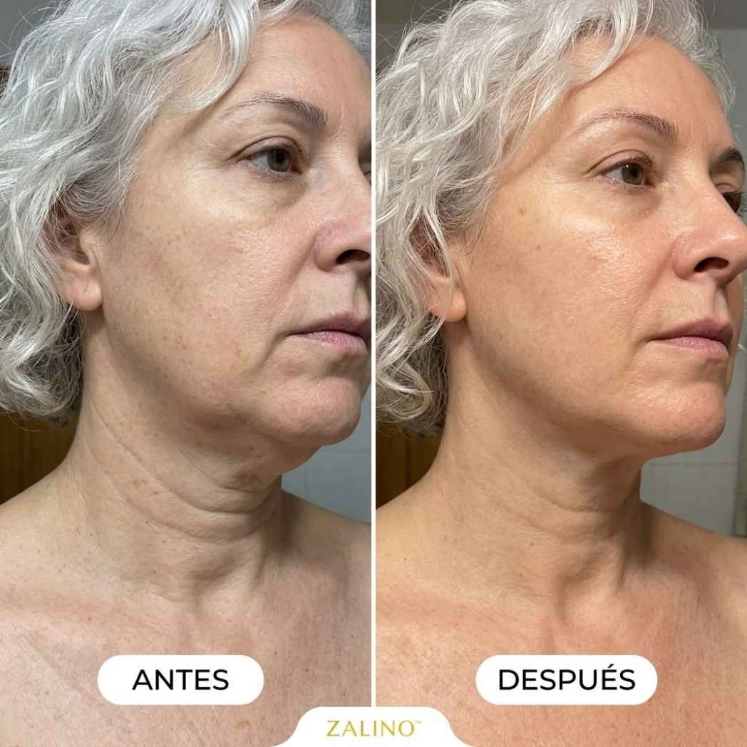 Masajeador Zalino Efecto Anti-Edad — Reafirma Tu Cuello en una Semana
